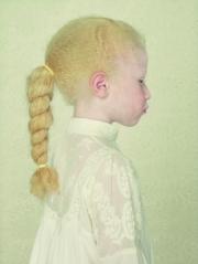 niña albina